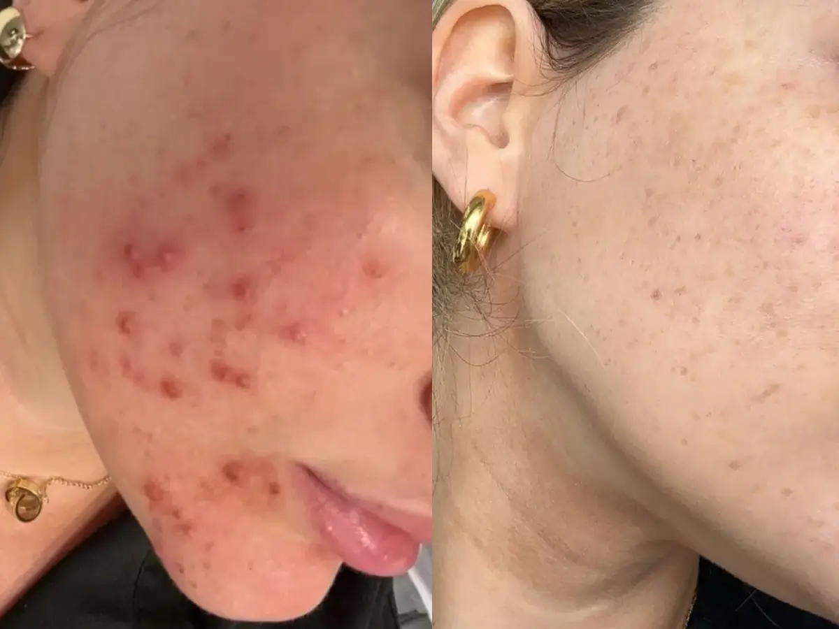 Antes e Depois Acne Intensa