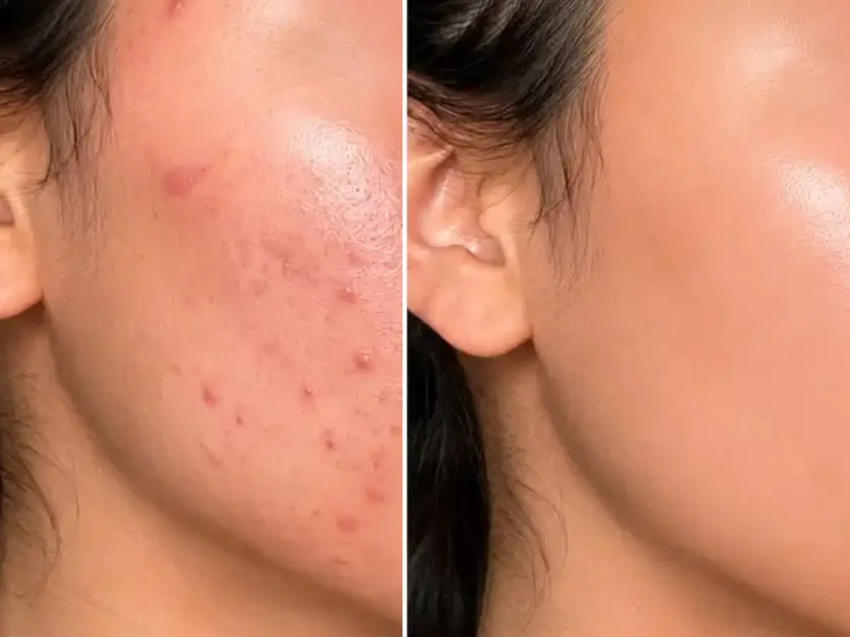 Antes e Depois Acne Profissional